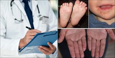 दिल्ली के डॉक्टर छोटे बच्चों में हाथ, पैर और मुंह की बीमारी में वृद्धि देख रहे
