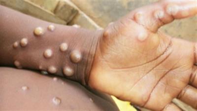 Africa CDC warns of rising mpox cases as death toll reaches 643