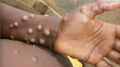 Africa CDC calls for enhanced surveillance, detection as monkeypox cases surpass 32,400