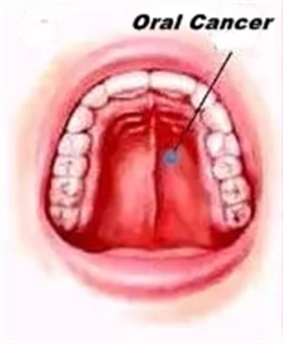 Smokeless tobacco, betel nut drive oral cancer cases in India, highest in South Asia: Lancet