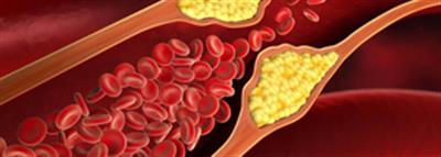 Covid infection spiked high cholesterol risk by 30pc: Study