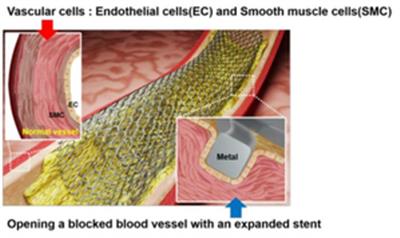 New laser patterning tech to revolutionise stent surgery for heart diseases