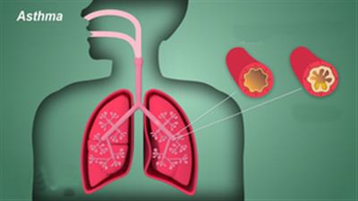 Targeted therapies, diagnostics remain concern for severe asthma: Report